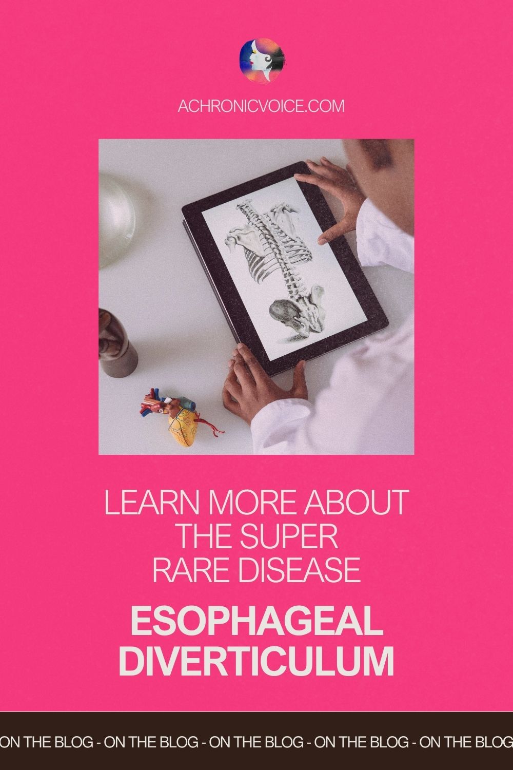 Learn More About the Super Rare Disease — Esophageal Diverticulum